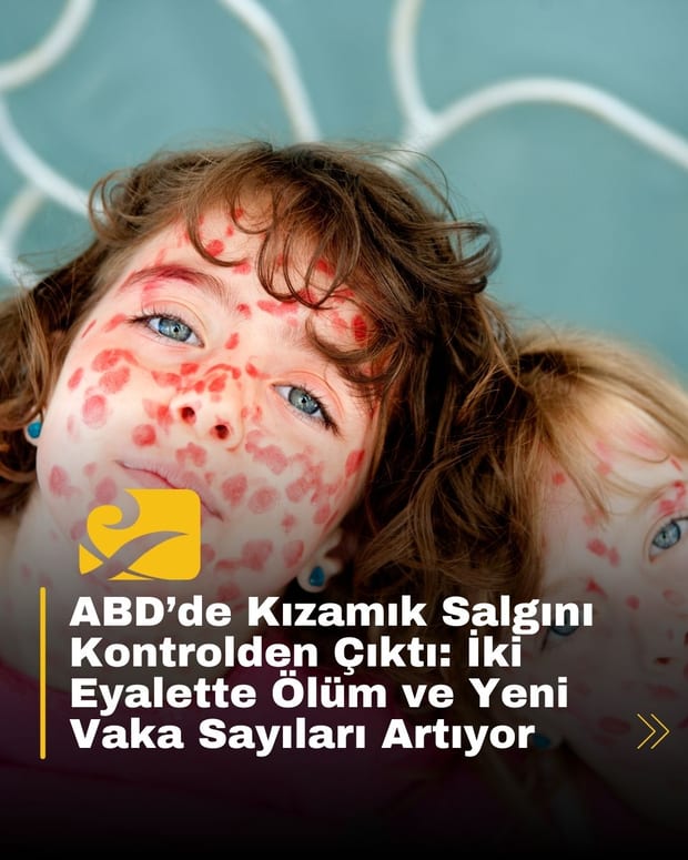 ABD’de kızamık salgını yayılıyor: Teksas ve New Mexico’da 230’dan fazla vaka görüldü