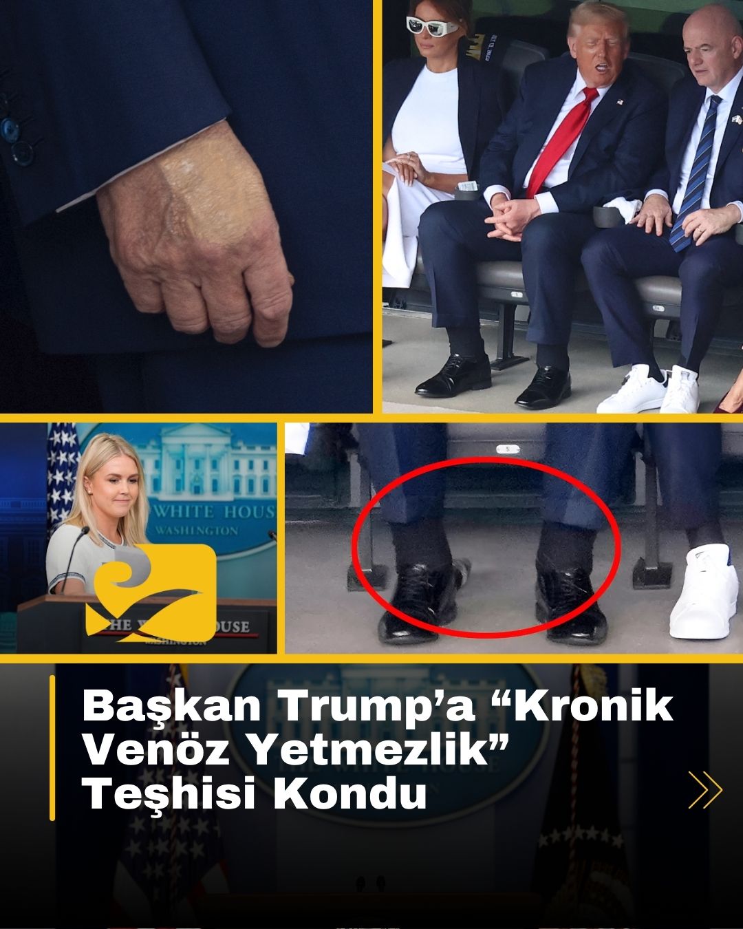 Trump’a kronik venöz yetmezlik teşhisi kondu